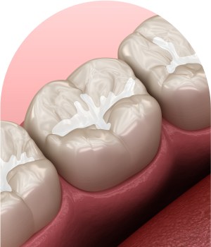 Dental Sealants Treatments in Royal Palm Beach, West Palm Beach, and Lantana, FL