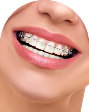 Braces in Royal Palm Beach, West Palm Beach, and Lantana, FL