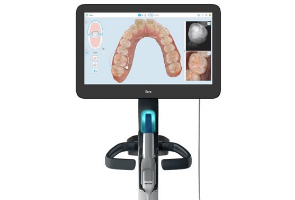 iTero Intraoral Scanner at Palm Beach Braces and Pediatrics in West Palm Beach, Royal Palm Beach, and Lantana, FL iTero Intraoral Scanner at Palm Beach Braces and Pediatrics in West Palm Beach, Royal Palm Beach, and Lantana, FL